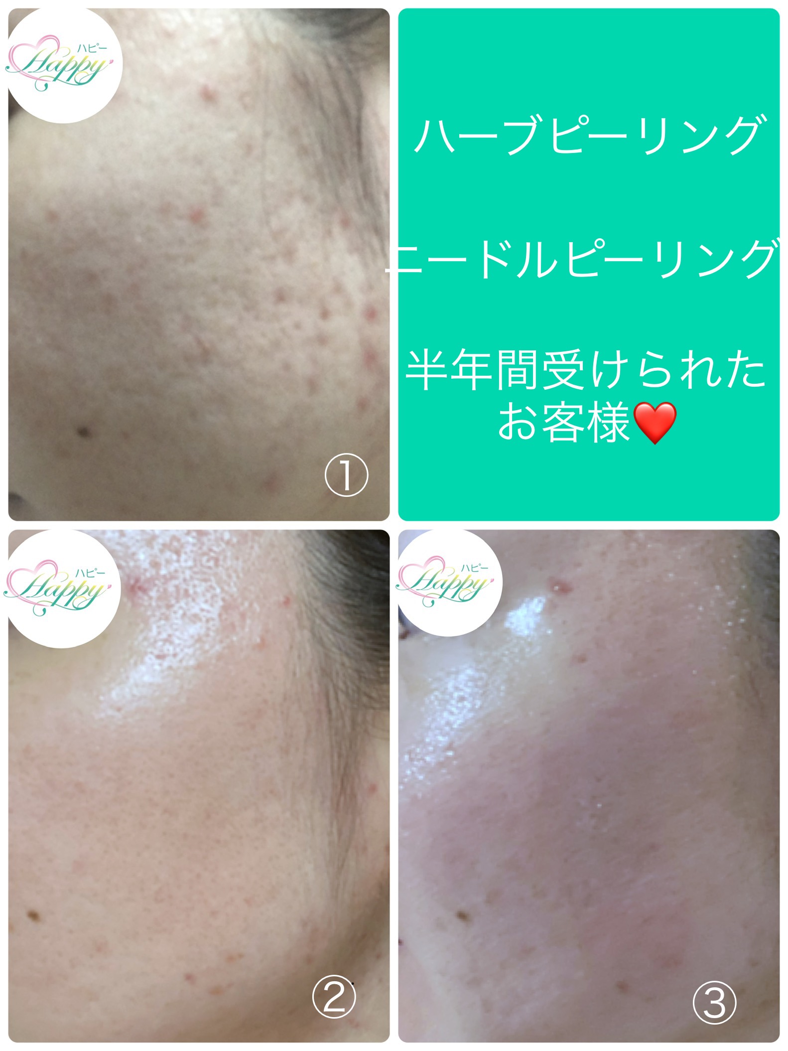 ハーブピーリングとニードルピーリング集中ケア | 大阪本町のBeauty